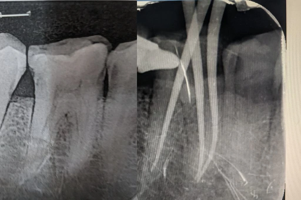Root Canal Treatment